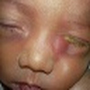 Oculoplastic & Oncology